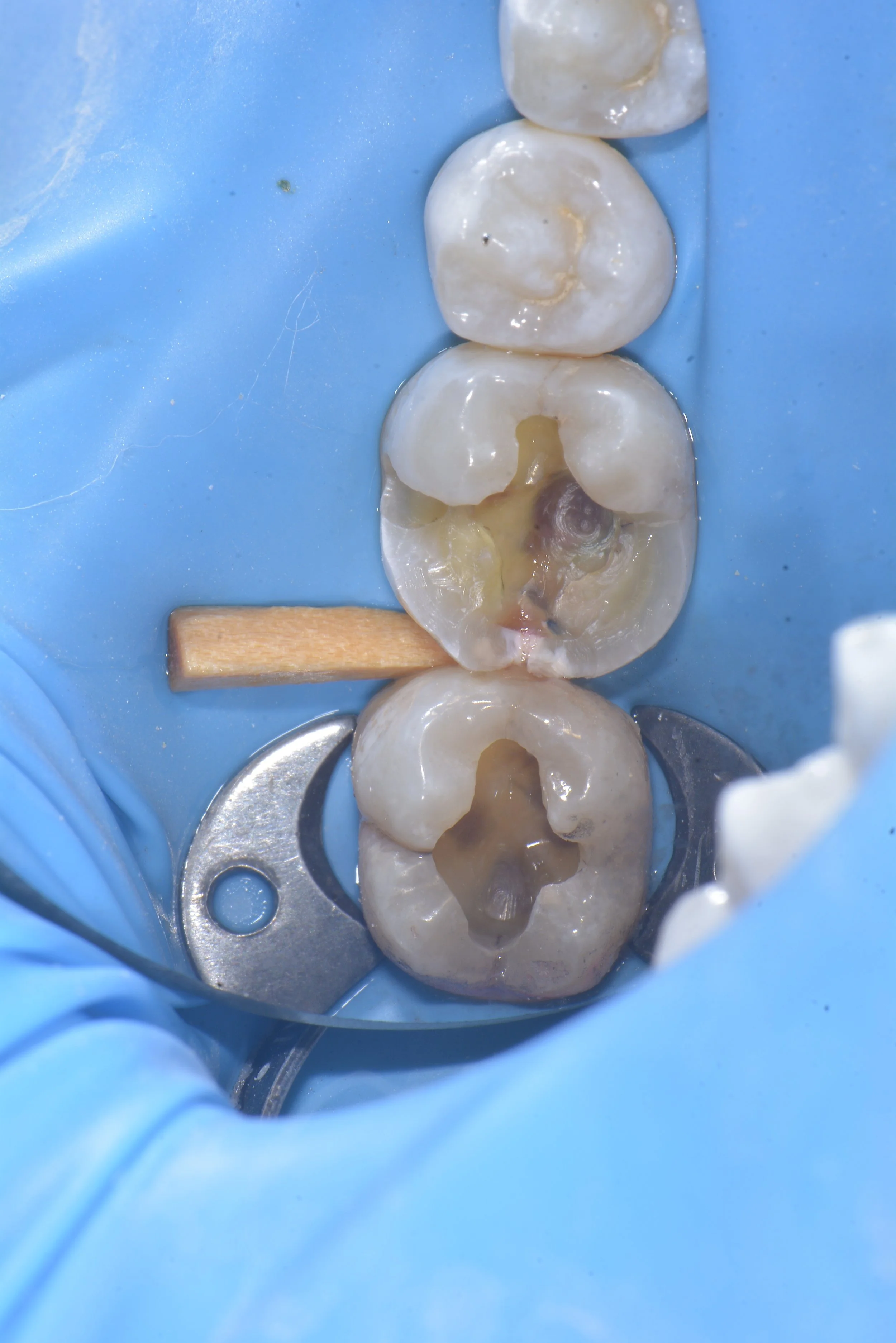 Peripheral Rim Fractures and Occlusal Effect Caries in Teeth